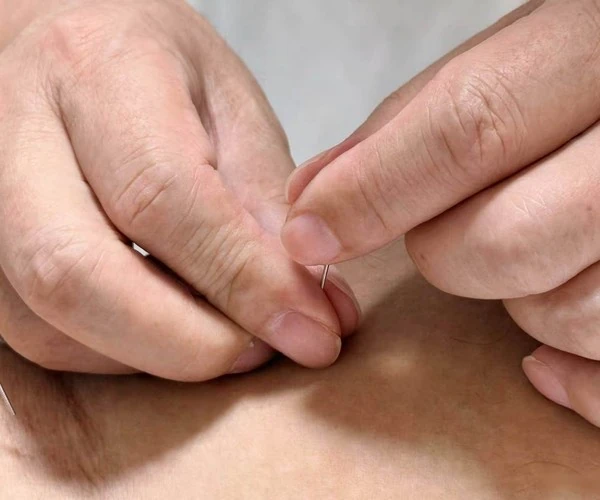 Acupuncture needling on lower leg / 小腿进针特写
