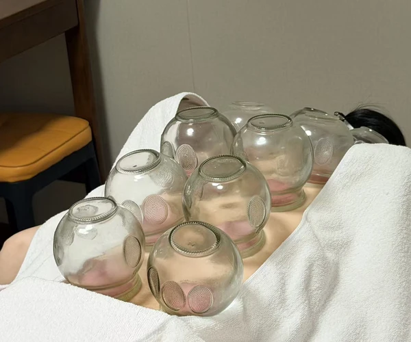 Cupping placement / 定罐